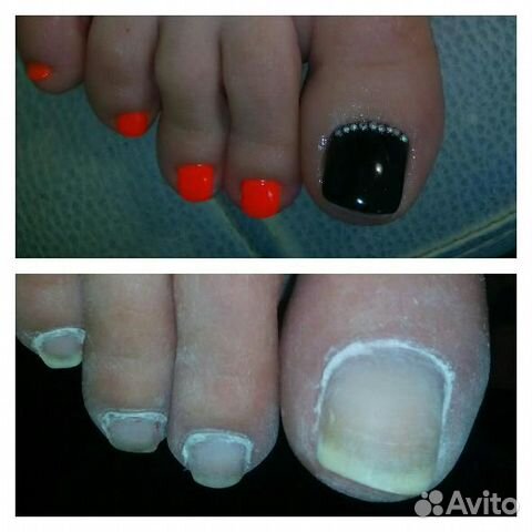 Педикюр подолог