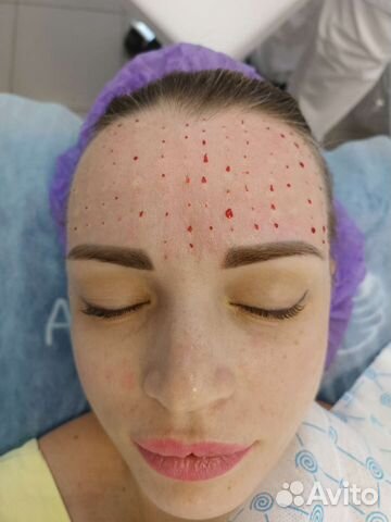 Биоревитализация